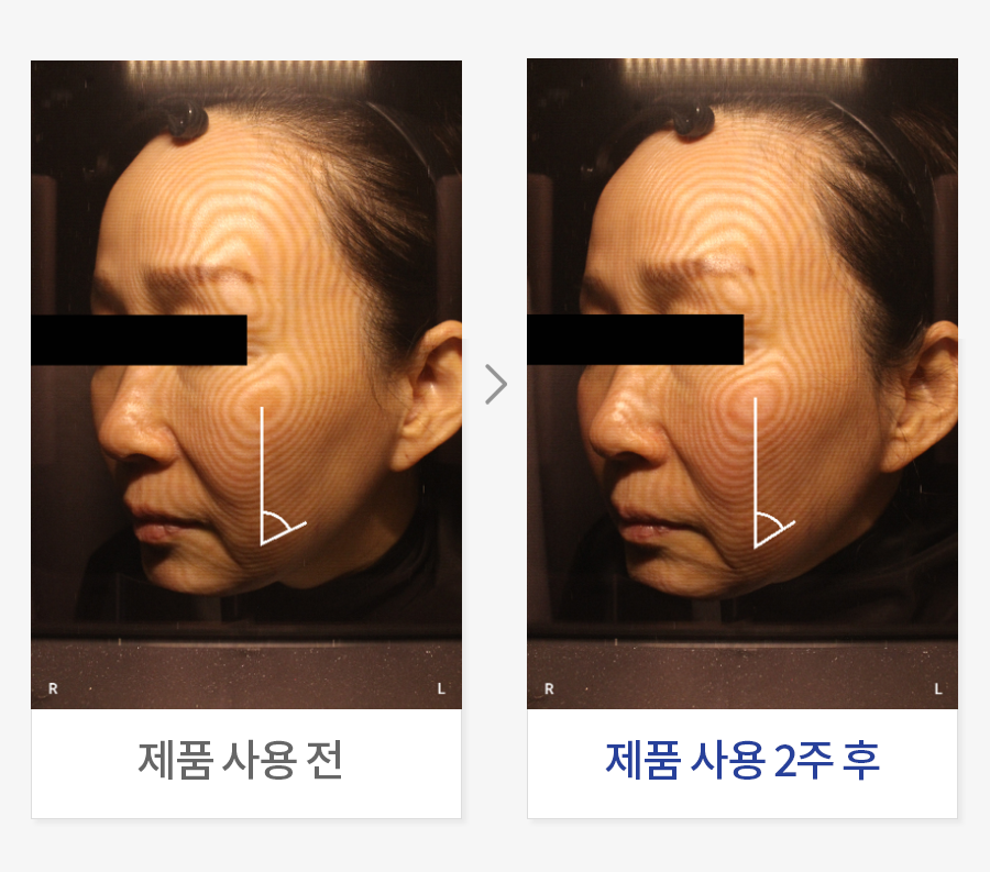 볼 리프팅 개선