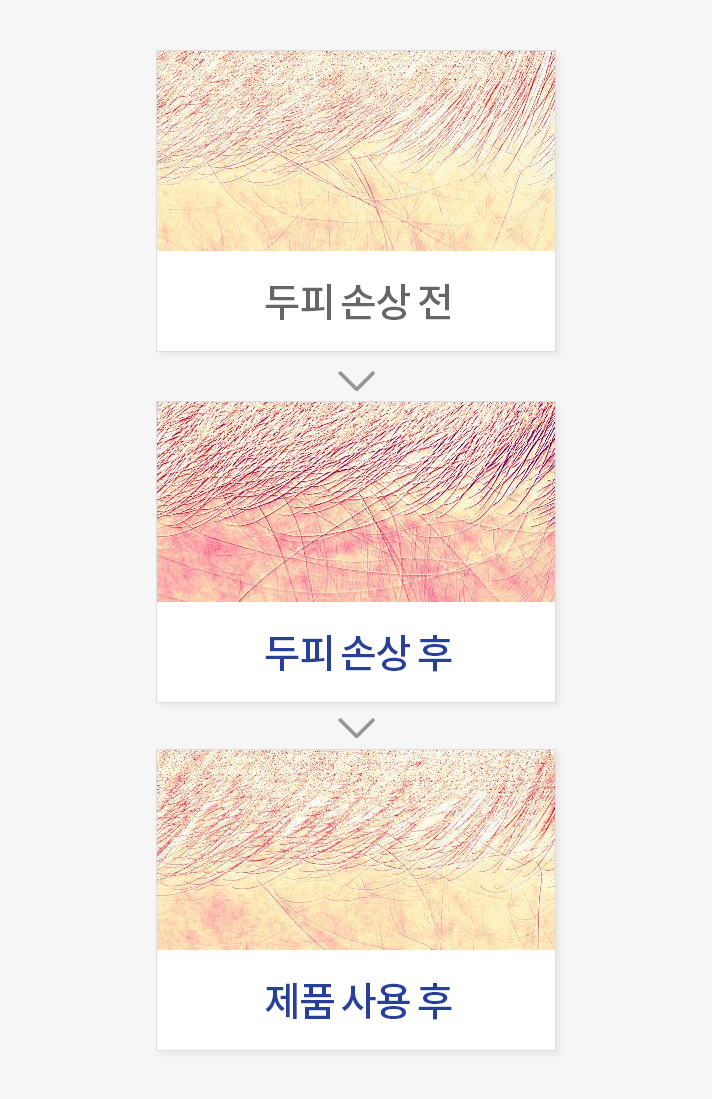 외부자극(물리적)에 의한 두피 진정