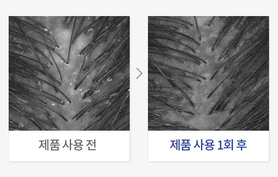 두피 각질 개선
