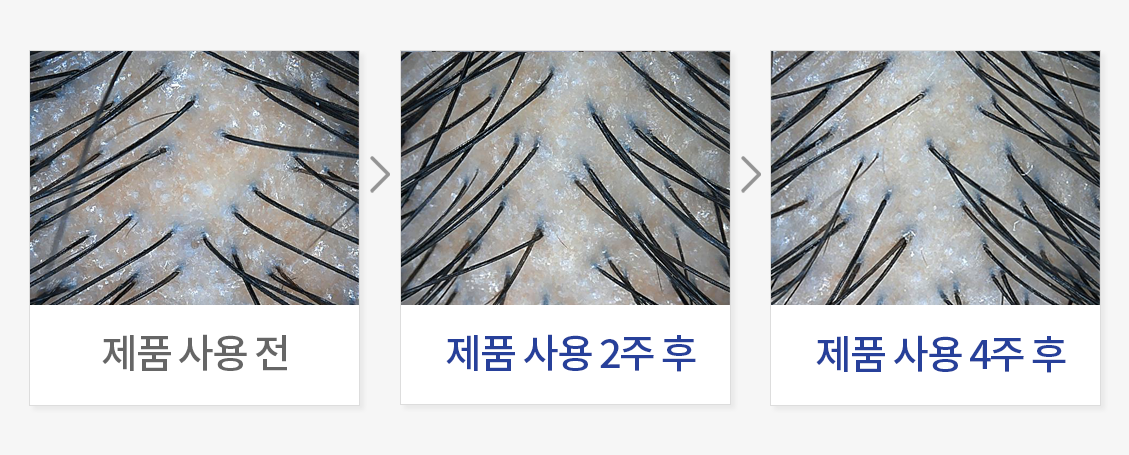 두피 비듬 및 가려움 평가