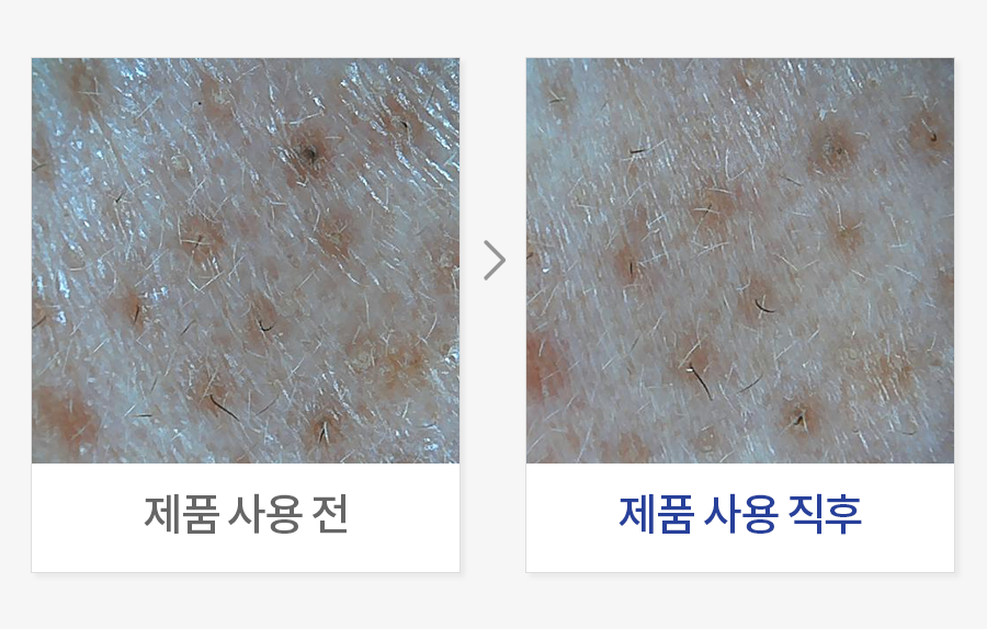 블랙헤드 개선