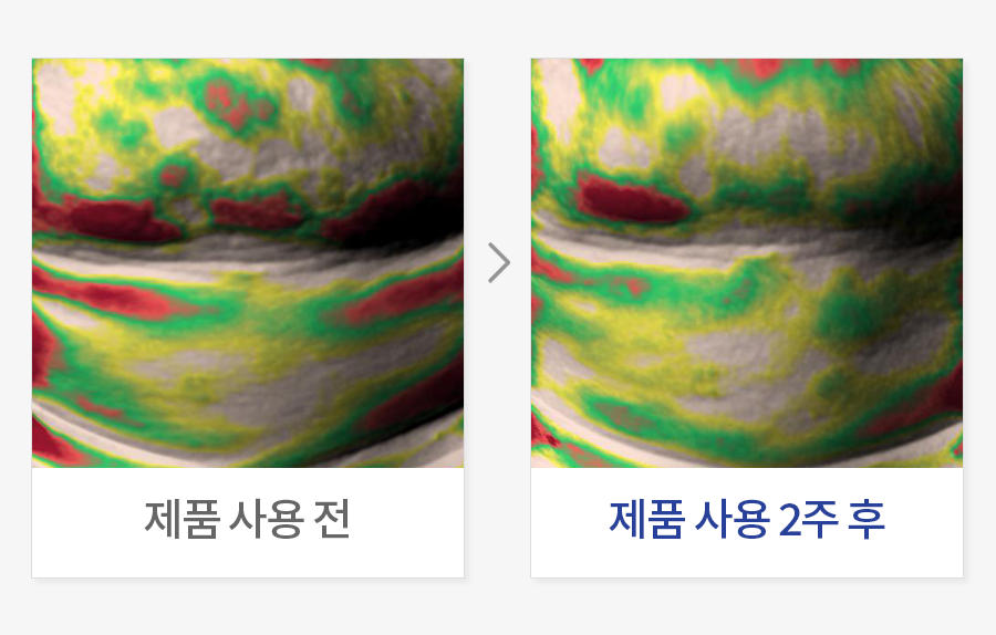이중턱 리프팅