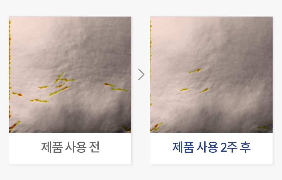 이마 주름 개선
