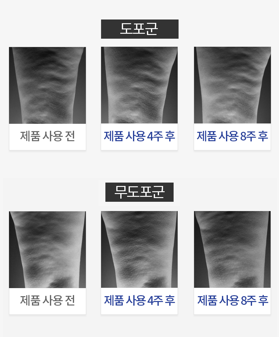 일시적 셀룰라이트 감소 평가