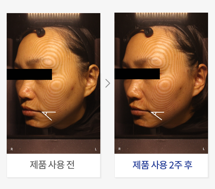 입가 리프팅 개선