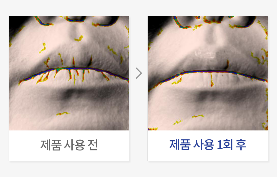 입술 주름 개선