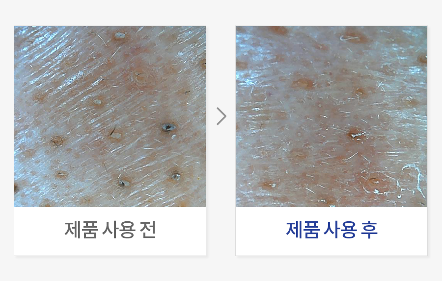 즉각적인 블랙헤드 세정력 평가