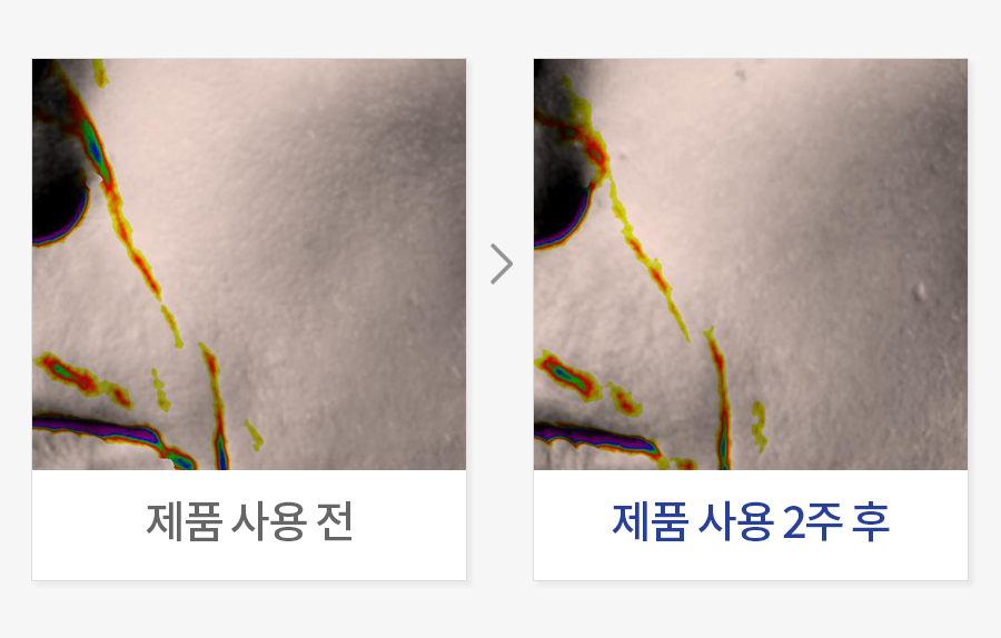 주름 폭 개선