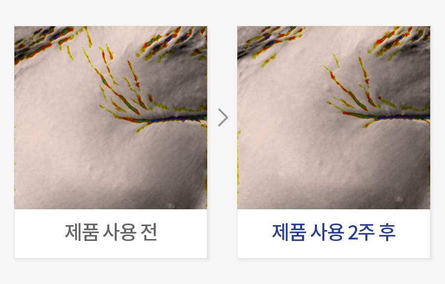 주름 수 개선