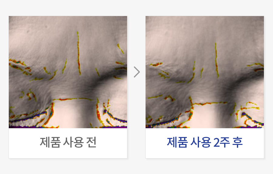 미간 주름 개선