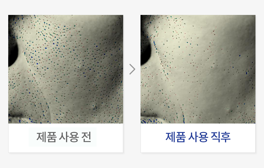 모공(면적, 볼륨, 수, 깊이)