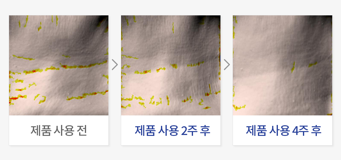 목 주름 개선