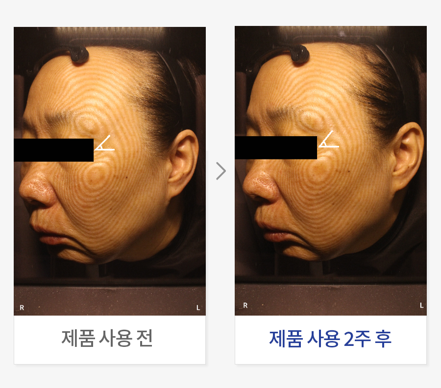 눈가 리프팅 개선