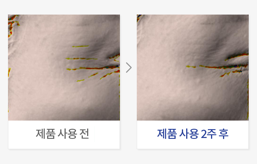 눈가 주름 개선
