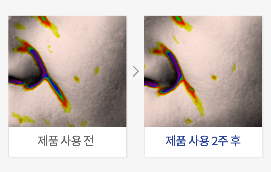 팔자 주름 개선