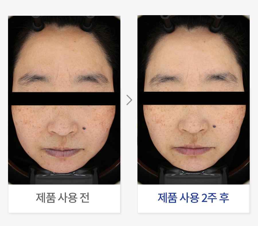 피부 밝기 개선