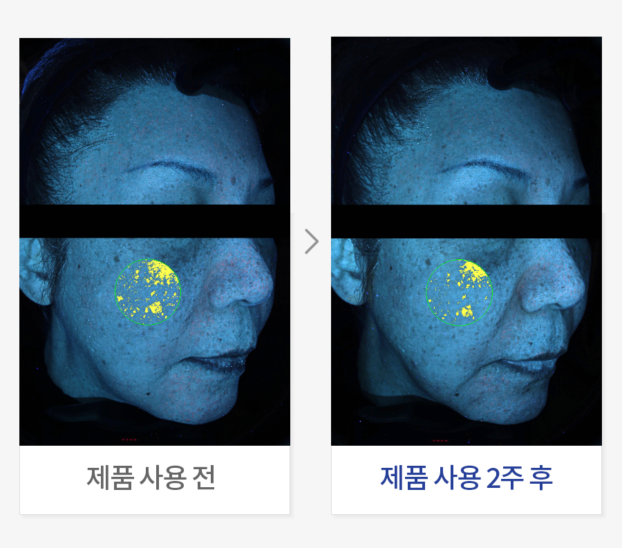 피부 속 기미 개선
