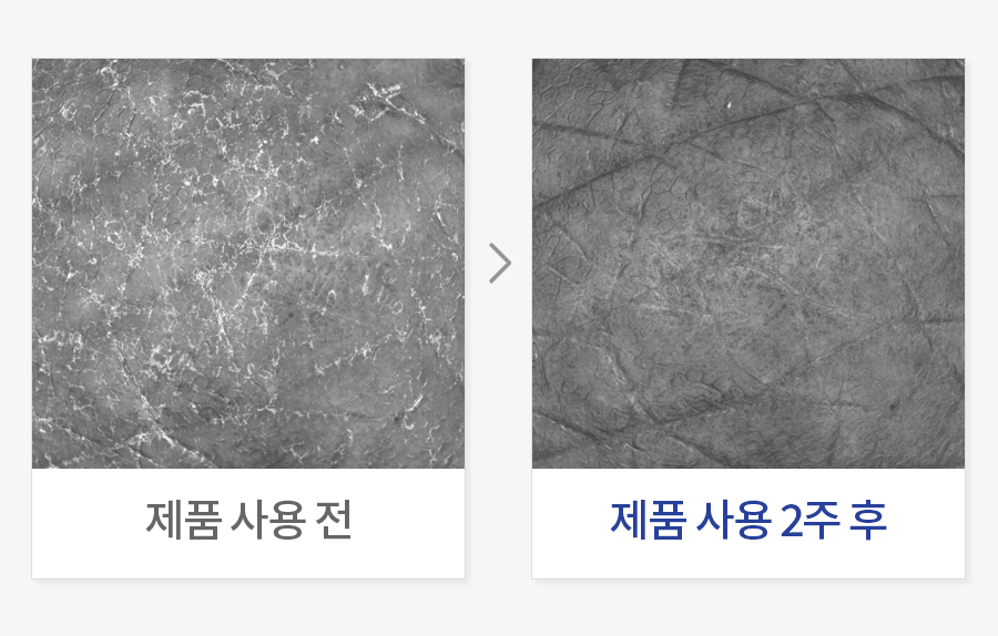 피부 각질 개선