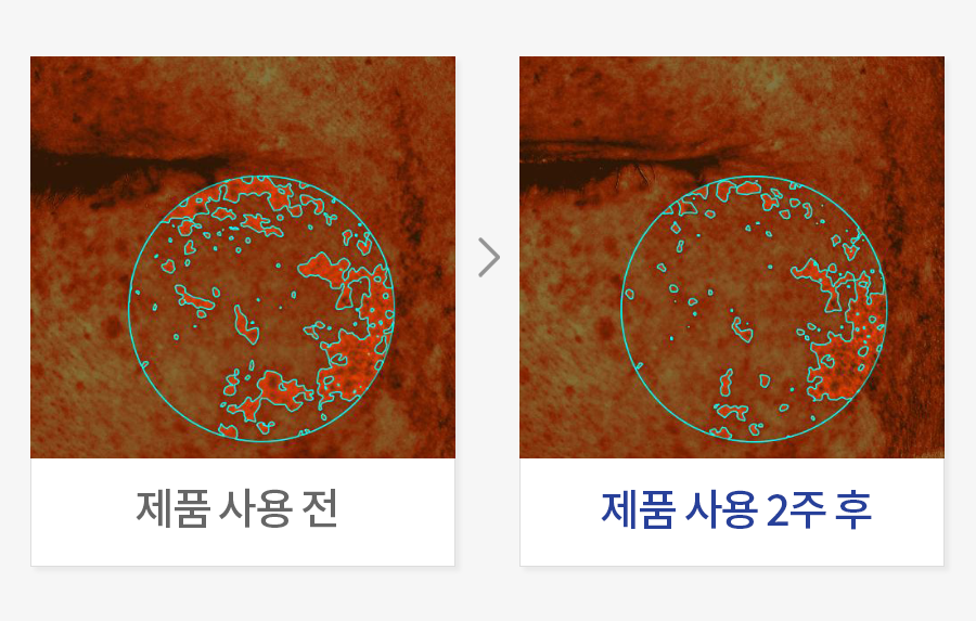 피부 기미 분포도 개선