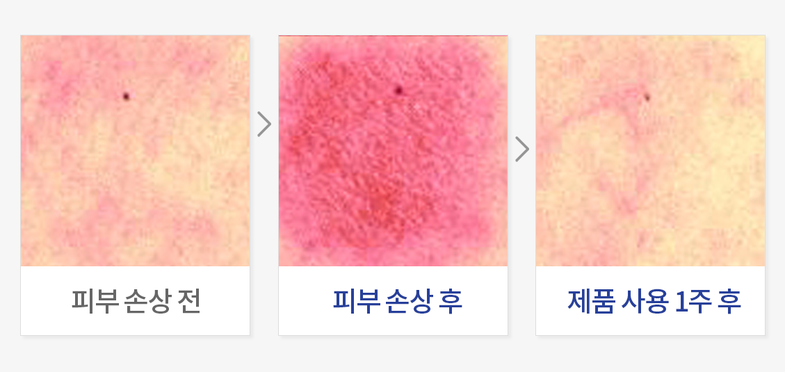 피부 진정(화학적 자극)