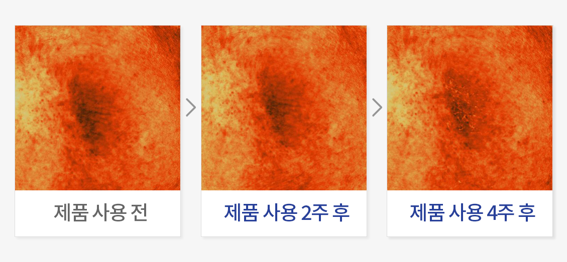 피부 멜라닌 개선 (무릎)