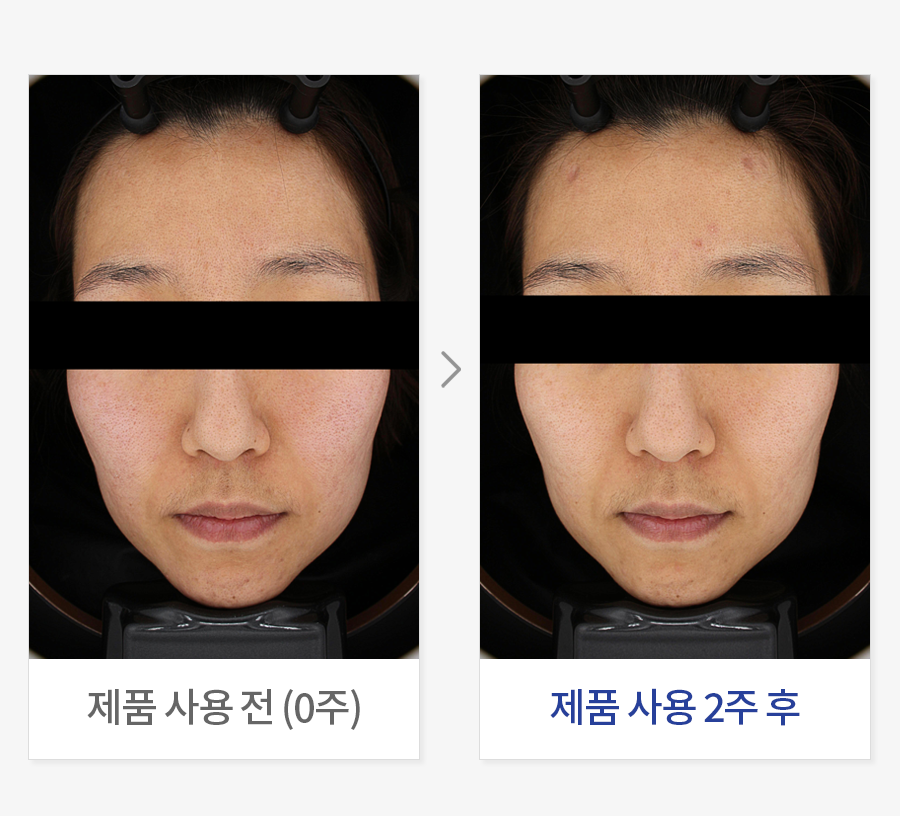 피부톤 개선