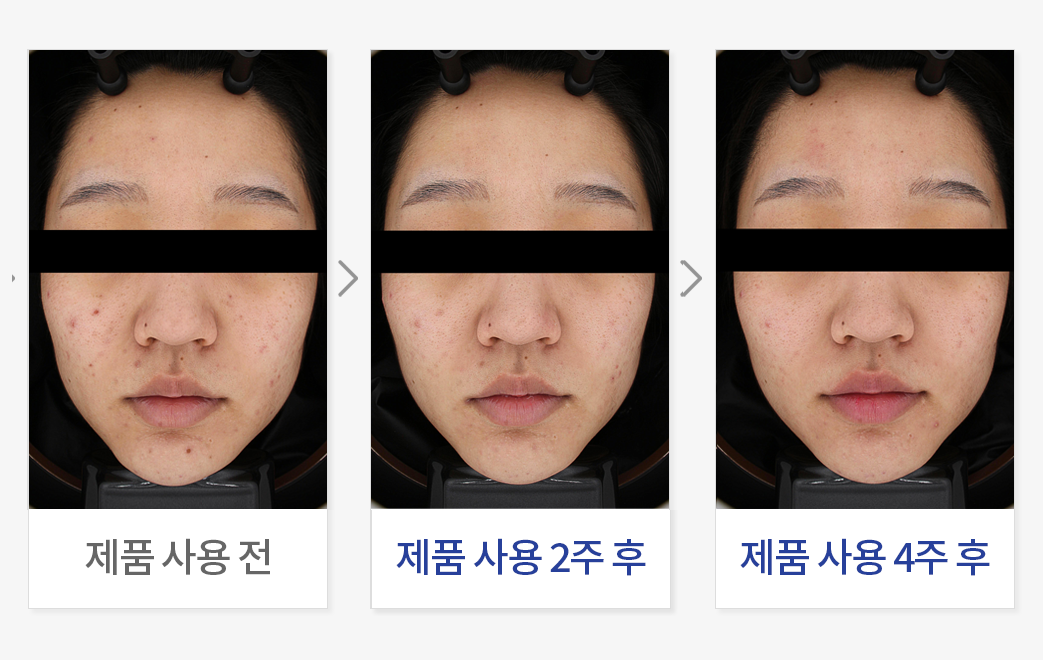 여드름성 피부 사용 적합성 평가 (Non-Comedogenic)